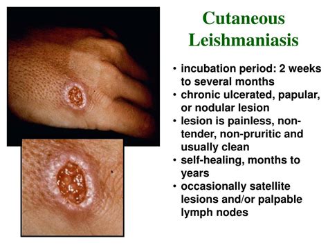 PPT Leishmaniasis PowerPoint Presentation Free Download ID