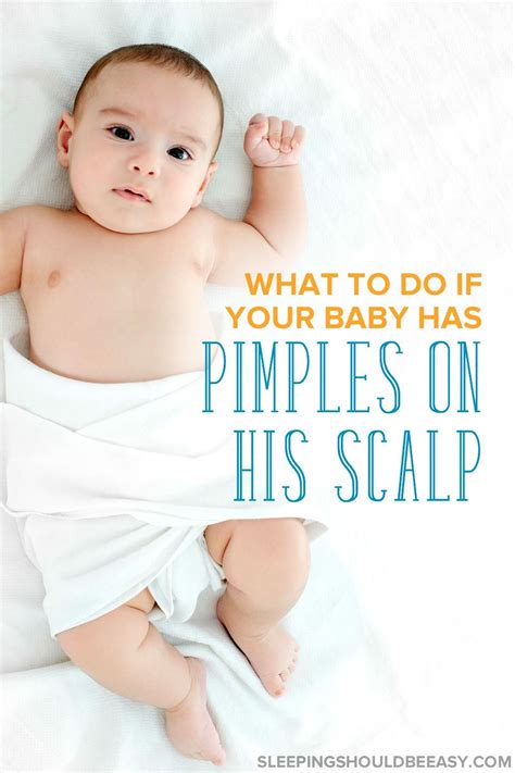 3 Essential Tips To Get Rid Of Pimples On Your Babys Scalp Baby Acne