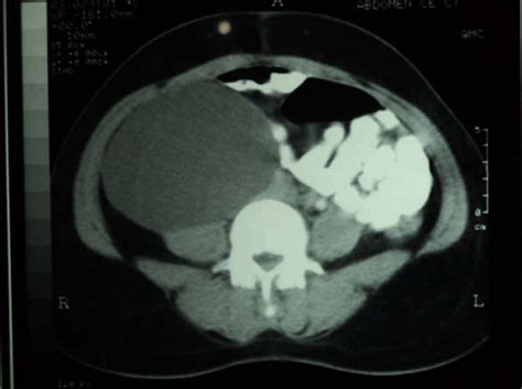 Full Text A Huge Retroperitoneal Lymphatic Cyst Presenting As A