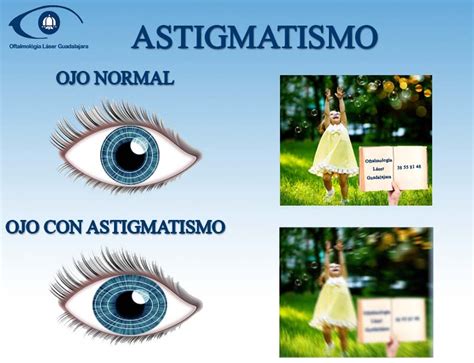 Astigmatismo Qué es causas y como se corrige