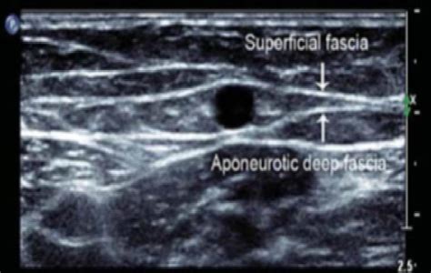 Ultrasound Appearance Of Saphenous Vein In The Thigh Download