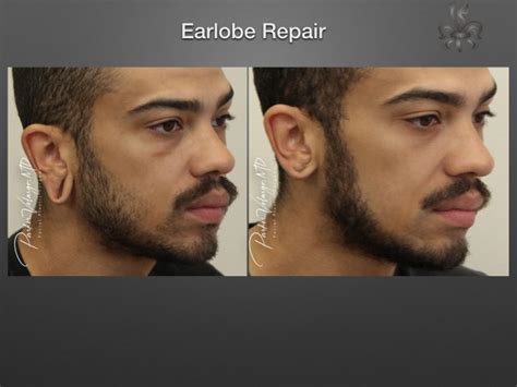 Earlobe Repair Archives New Orleans Premier Center For Aesthetics And