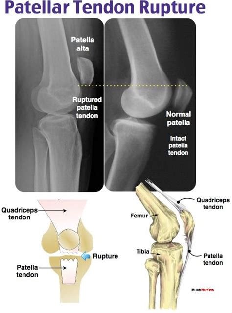 Patellar Tendon Rupture Radiology Student Medical Anatomy Emergency
