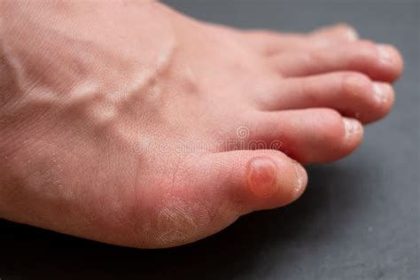 Callus On Pinky Toe After Wearing Uncomfortable Shoes Close Up View