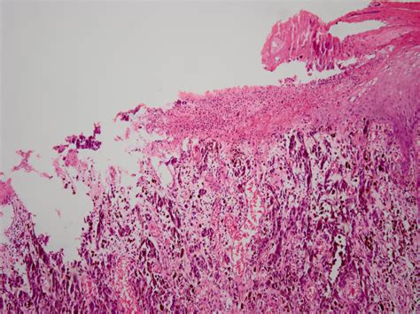 Malignant Melanoma Histology