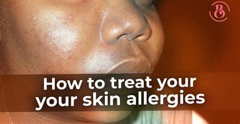 How To Treat Your Skin Allergies Beaucrest