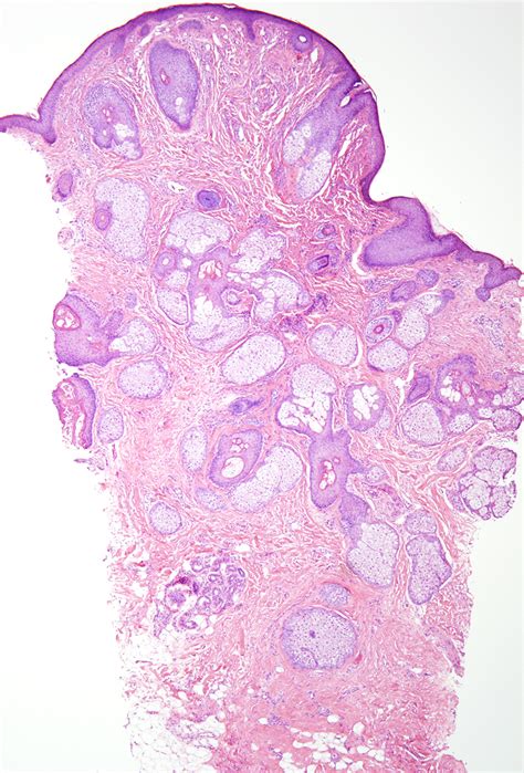 Fibrous Papule Dermatopathology