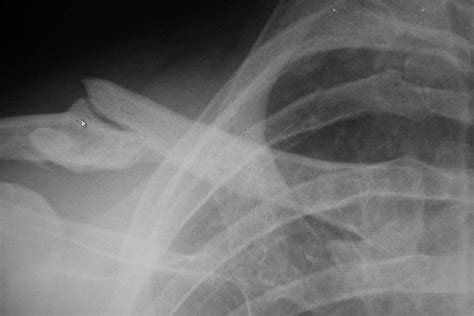 Lightning Does Strike Twice Another Broken Collarbone Lifestyle