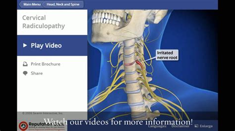 Cervical Radiculopathy Tampa Pain Physicians 813 961 1314 Youtube