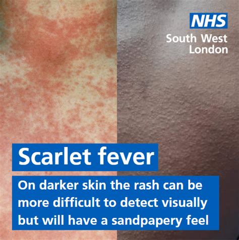 Scarlet Fever What You Need To Know Wandsworth Borough Council
