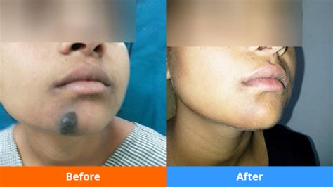 Dr Goutam Guha Facial Cosmetic Surgery India Kolkata Scar