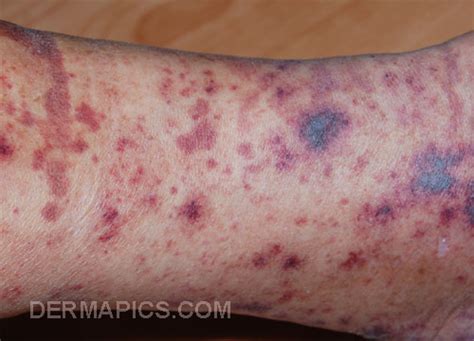 Red Spots And Rash The Most Common Types Compared