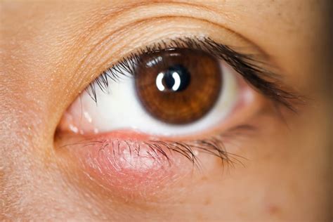 Stye In Eyelid Types Symptoms And Treatment Eye Solutions