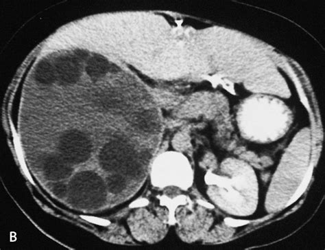 Type Ii Hydatid Cyst In The Left Lobe Of The Liver Education Info
