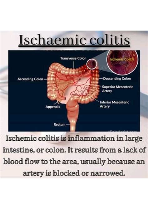 Solution Ischaemic Colitis Ischaemic Colitis Causes And Clinical