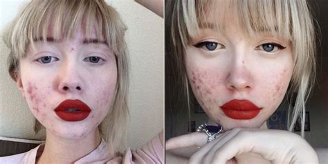 Acne Positivity Why People Are Posting Selfies On Instagram Web Top News