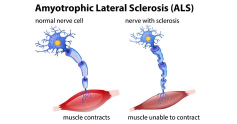 Amyotrophic Lateral Sclerosis Als Causes Symptoms And Treatment