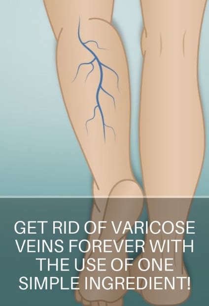 Get Rid Of Varicose Veins Forever With The Use Of One Simple Ingredient