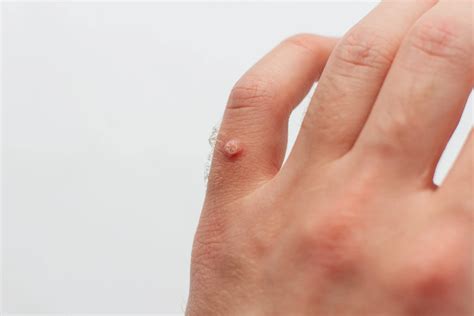 Plantar Warts Wart Removal Midwest Express Clinic
