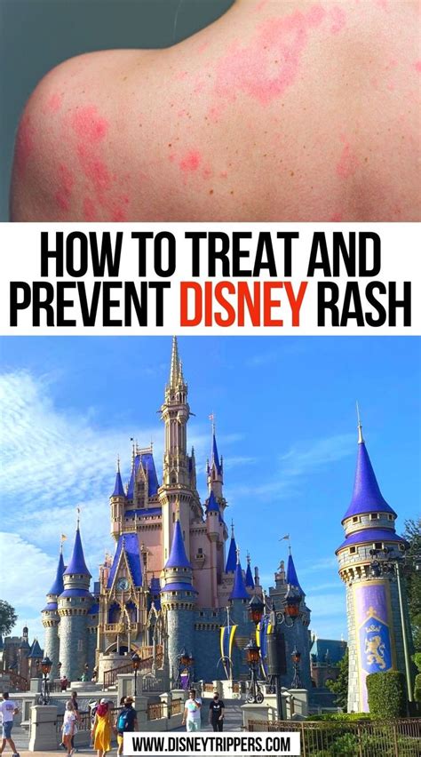 How To Treat And Prevent Disney Rash In 2021 Disney Rash Disney Trip