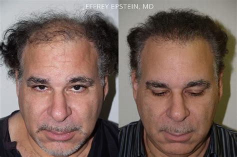 Hair Transplants For Men Photos Miami Fl Patient