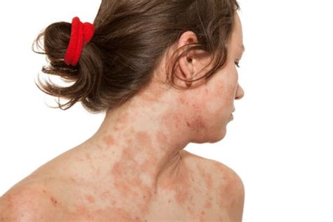 Atopic Eczema Prevalence Remains High After Childhood Dermatology Advisor