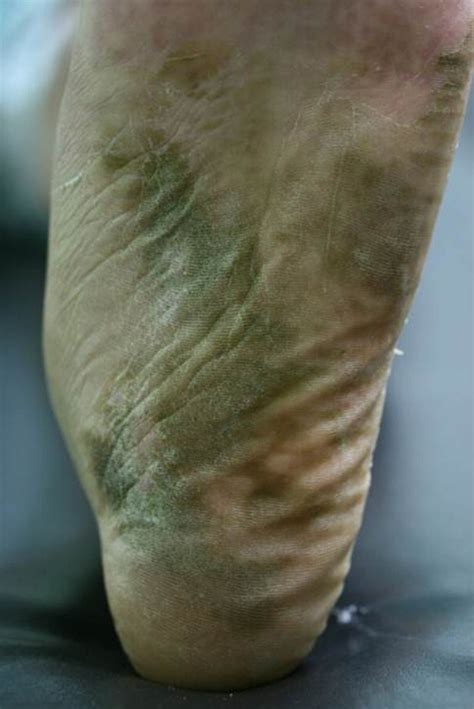 Green Foot Syndrome A Case Series Of 14 Patients From An Armed Forces