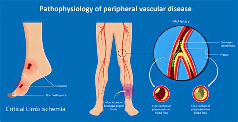 What Is Peripheral Artery Disease Causes Signs Sympto