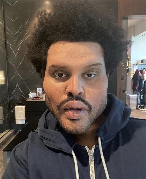 This Picture Of The Weeknd After Plastic Surgery Runcannyvalley