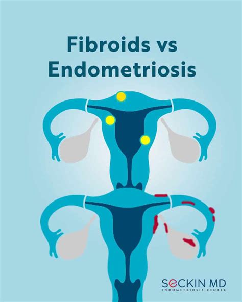 fibroids vs endometriosis seckin endometriosis center