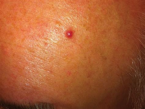 NCCN Guidelines Implementation in the Multidisciplinary Merkel Cell