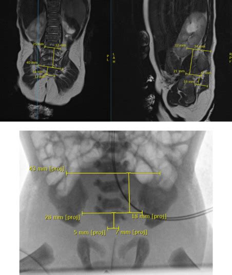 Assessment Of Sacral Ratio In Patients With Anorectal Malformations