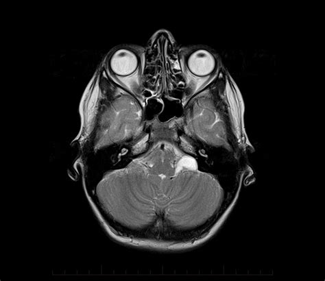 Mri Brain Pineal Cyst 0001 800 Mri At Melbourne Radiology Clinic