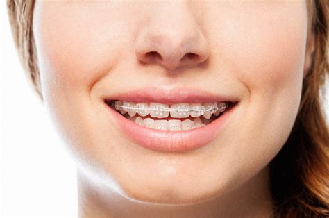 Invisible Braces Pros Cons And Costs