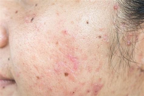 How To Treat The Most Common Types Of Acne Scarring