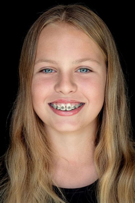 Pin By John Beeson On Girls In Braces In People Connecting