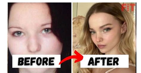 Dove Cameron Plastic Surgery Before And After