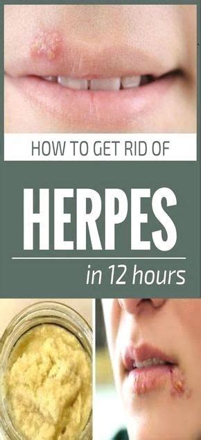 best home remedy to get rid of herpes in 12 hours healthytop001