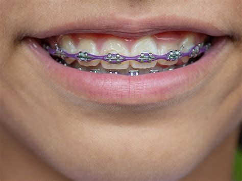 How Long Does It Take For Braces To Straighten Teeth General And Cosmetic Dentistry