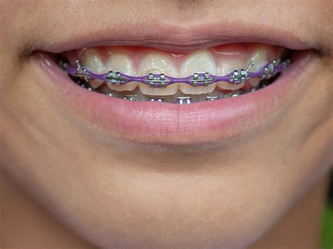 How Long Does It Take For Braces To Straighten Teeth James D Geren Dds Alexandria Virginia