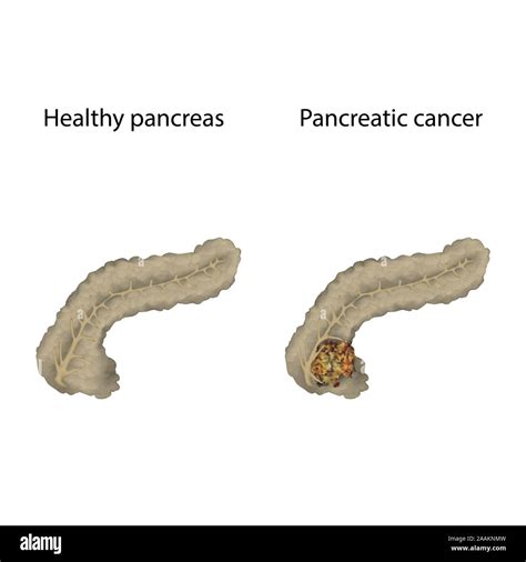 Pancreatic Cancer And Healthy Pancreas Illustration Stock Photo Alamy