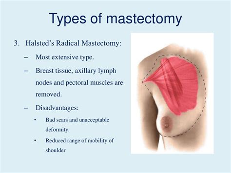 Mastectomy