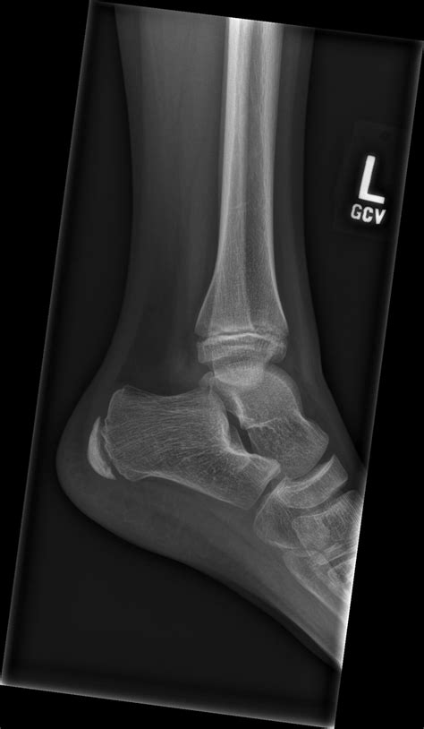 Orthodx Ankle Sprain Or Salter Harris Injury Clinical Advisor