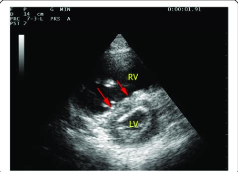 Pulmonary Embolism Ultrasound