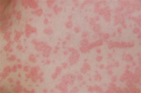 How Can You Tell If You Have An Amoxicillin Rash