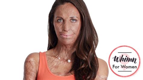 Turia Pitt On Grassfire Recovery I Definitely Felt Like Tapping Out
