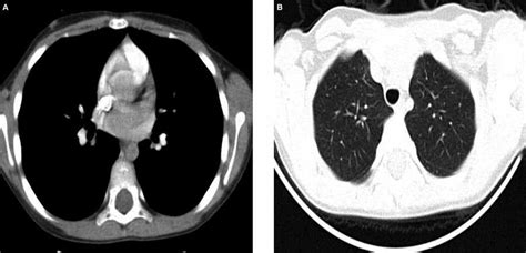 Abnormal Focal 99mtc Dmsa Uptake In The Lung — Report Of Two Cases
