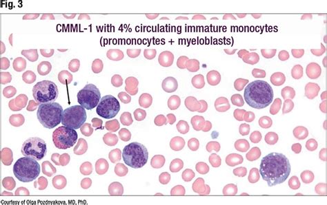 Close Up On Abnormal Monocyte Morphology In Peripheral Blood Smears