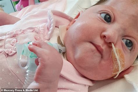 Baby Born With Webbed Fingers And Toes Will Have Life Changing Surgery