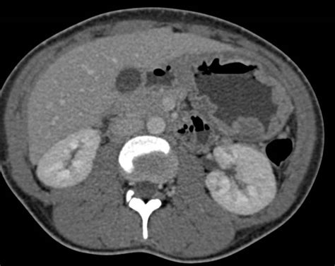 Gastric Lymphoma Stomach Case Studies Ctisus Ct Scanning